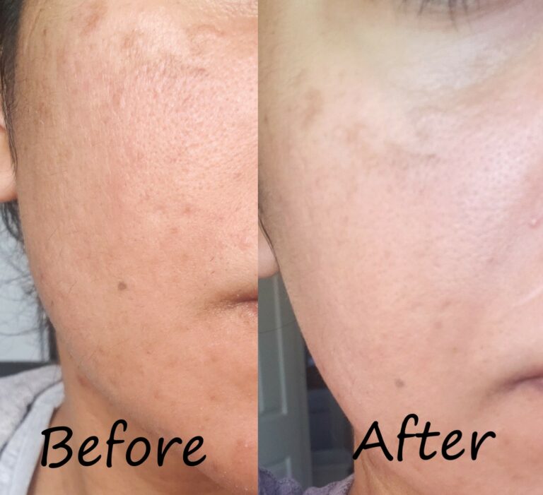 Chantecaille Purifying & Exfoliating Phytoactive Solution Review The